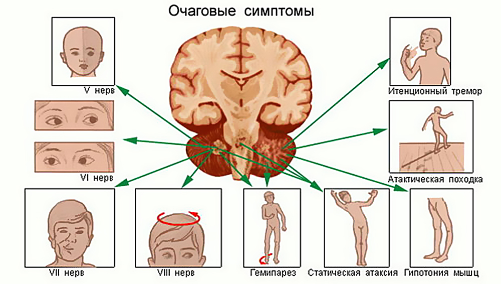 опухоль головного мозга симптомы